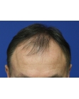 Before Hair Transplant&nbsp;Front